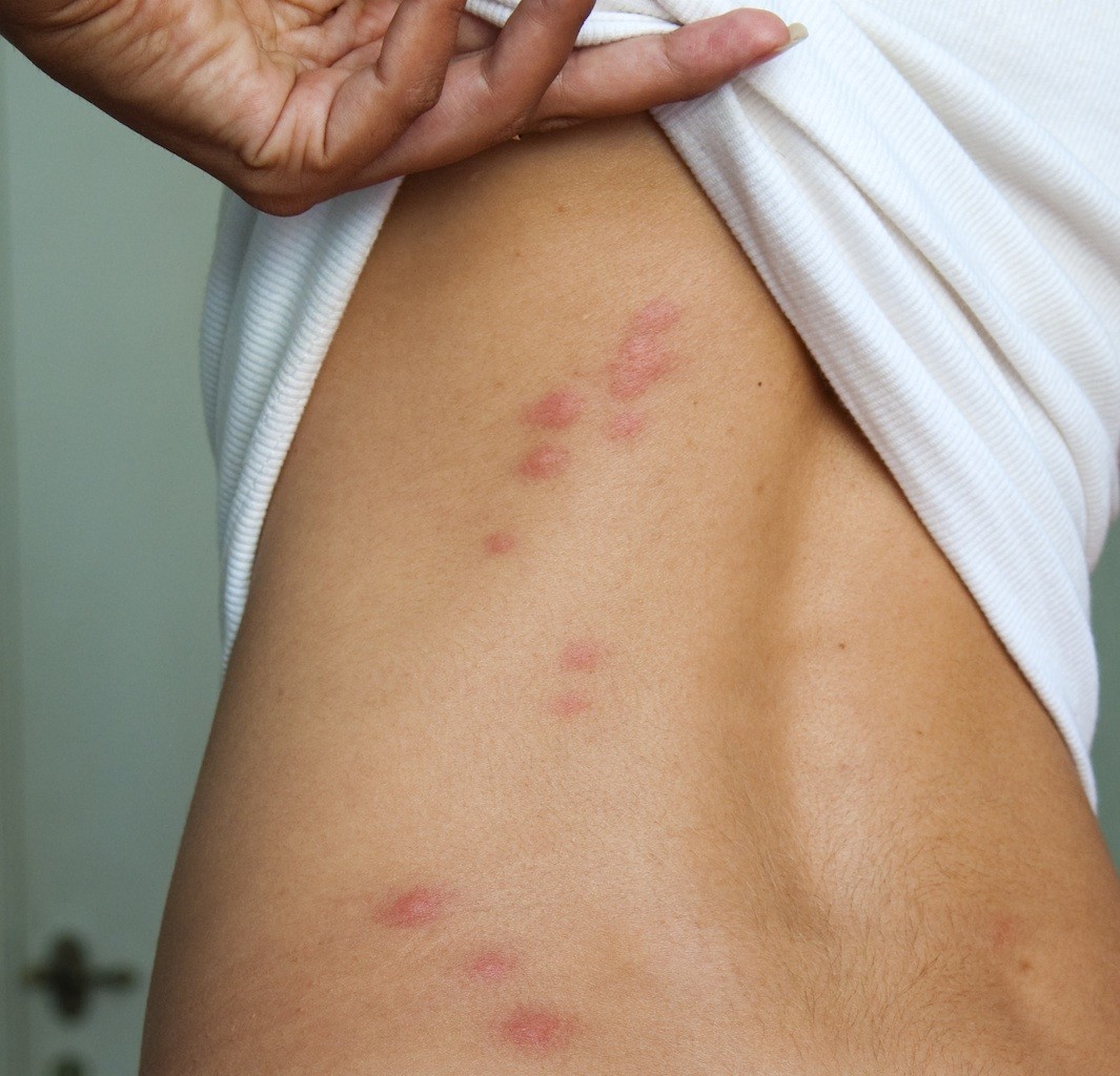 Bedbugs: Infestations, Bedbug Bites, and Getting Rid of ...
